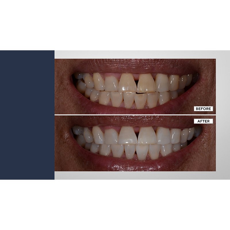 Teeth Whitening Service Birmingham MI - More Than a Dental Office