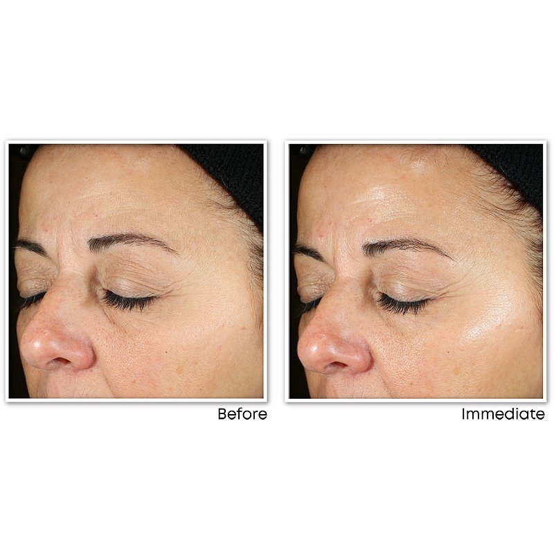 roc deep wrinkle serum before and after pictures